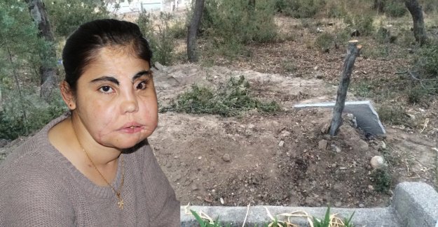 Türkiye’nin yüz nakli yapılan ilk kadını son yolculuğuna uğurlandı