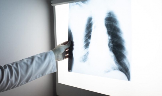 Yaygın akciğer kanserinde 'SBRT' yaşam süresini artırdı