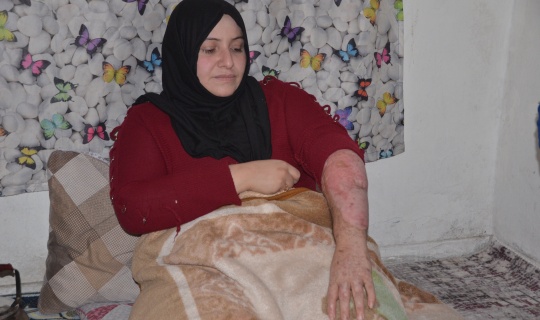 Suriyeli savaş mağduru kadın vücudundaki yanıklarla hayata tutunmaya çalışıyor